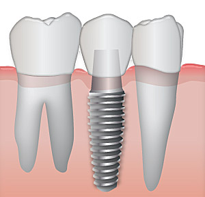 single_tooth_implant